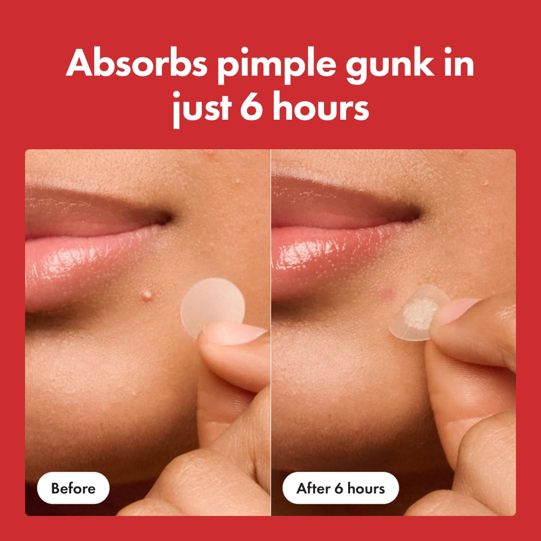 Fame Aura™ Dots for Spots – Pimple Patches